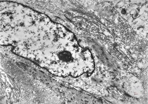 M,52y. | myofibroblastic tumor - pleura